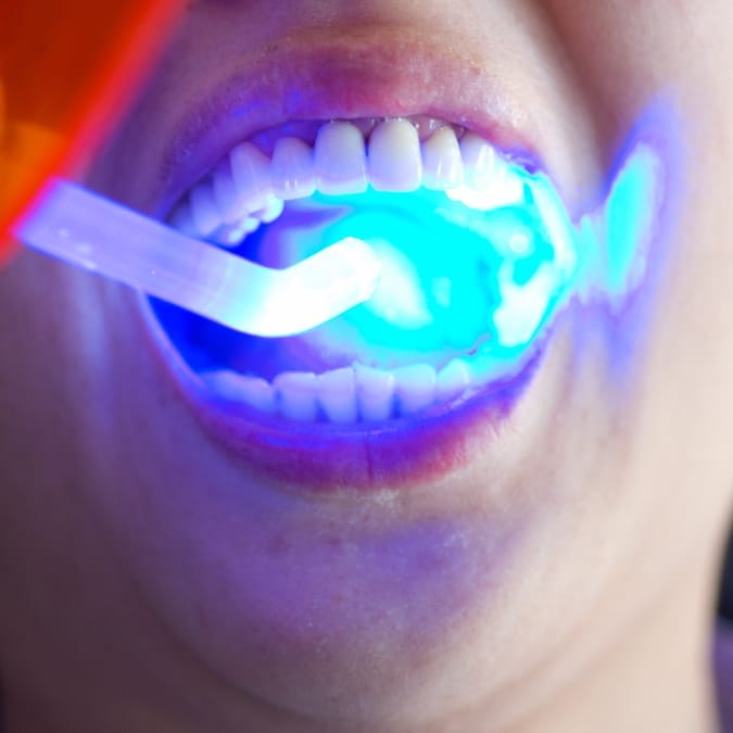 Unsafe teeth whitening practices