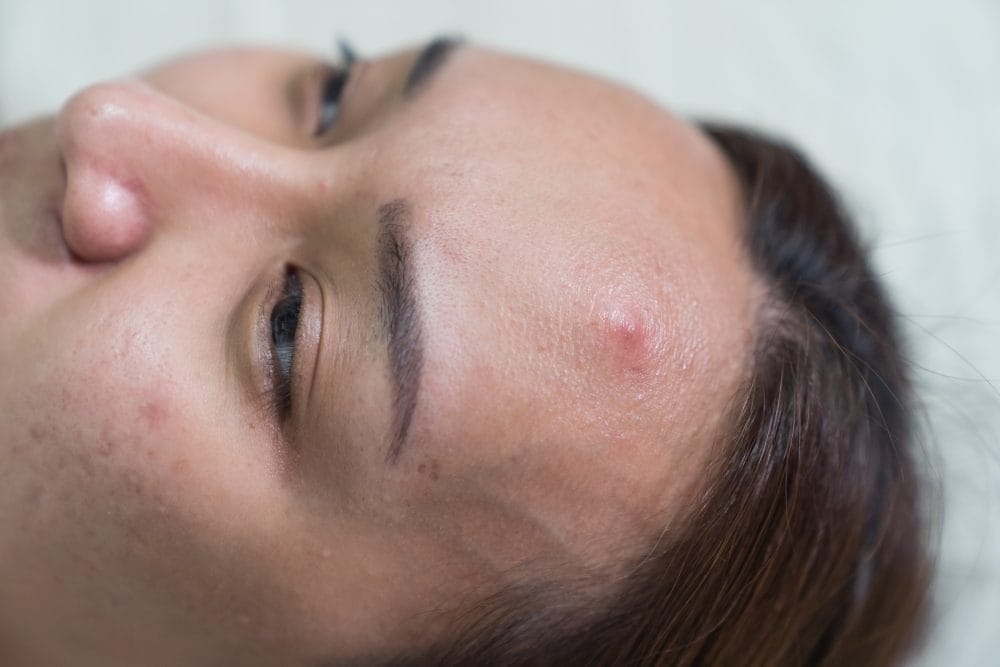 Reducing Skin Irritation